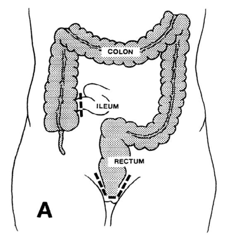 Ulcerative Colitis Information - Paul E. Savoca